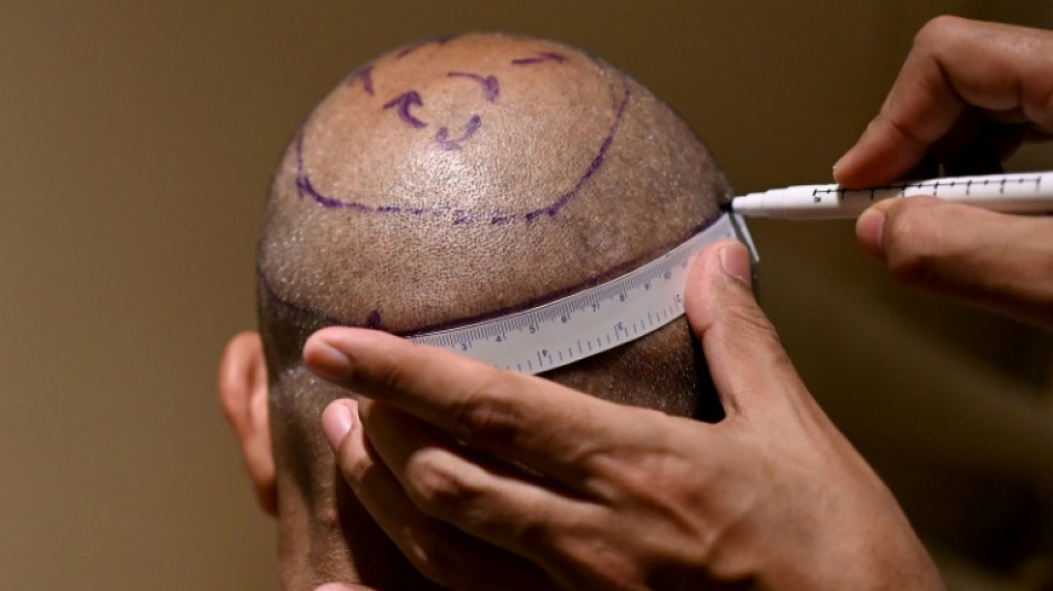 En Inde, la greffe capillaire, une pratique dangereusement d&eacute;voy&eacute;e par les charlatans